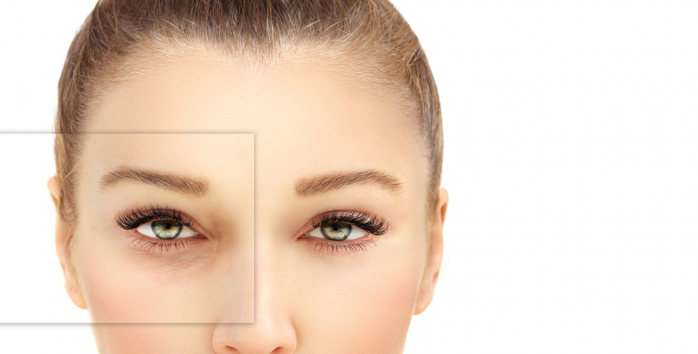 Blepharoplasty - Eyelid Surgery