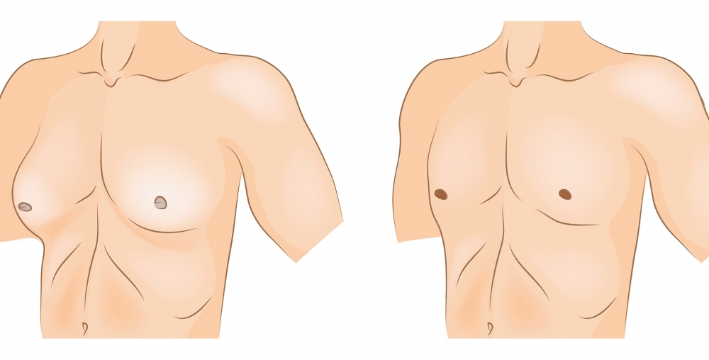 جراحة تجميل التثدي للرجال