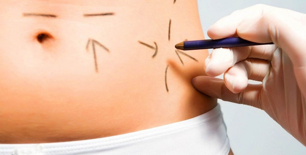 Lipoplasty - Tummy Tuck