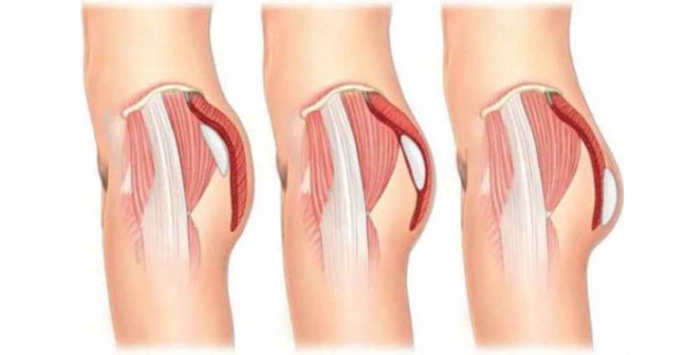 Buttock Augmentation